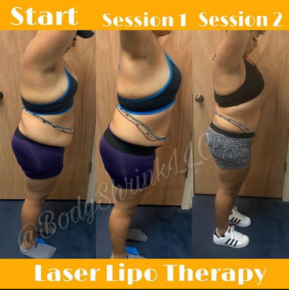 30 min Lipo Therapy In-Office Session